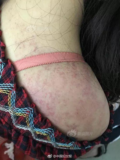 Doctors created a new treatment for eczema that reduces itching and inflammation