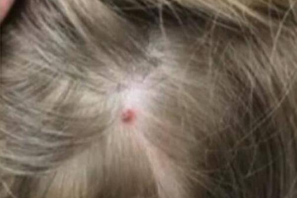 A research team made a breakthrough in finding a cure for a common virus